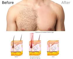 Hair removal options for men